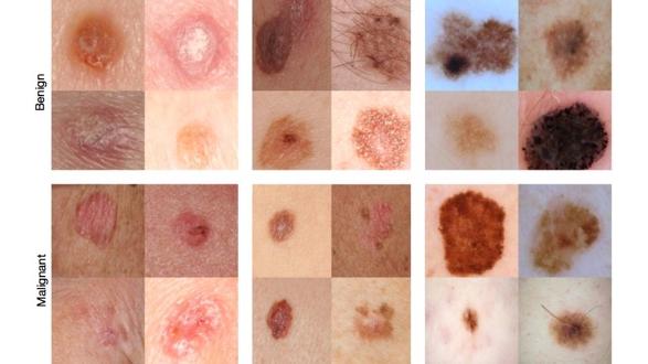 Cancers de la peau quand l ordinateur dépiste mieux que les dermatologues