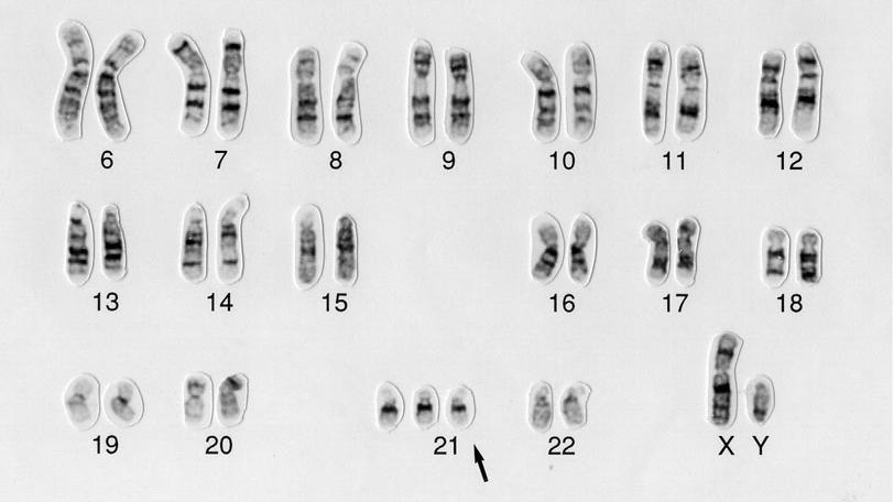 Кариотип синдрома дауна картинки