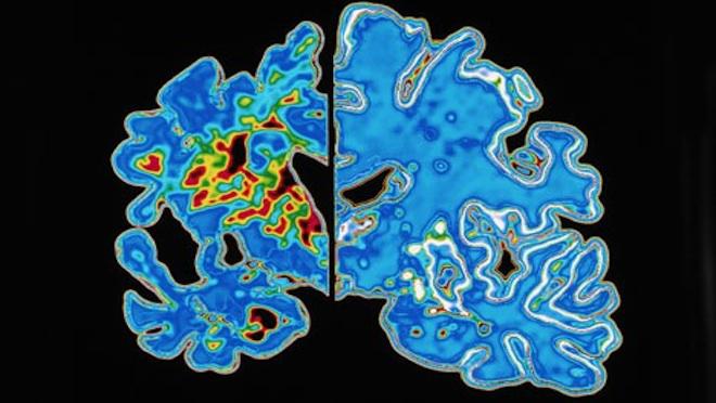 maladie d'alzheimer génétique - alzheimer héréditaire