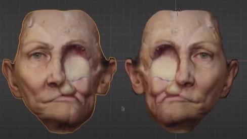 Reconstruction faciale : un nouveau visage grâce à l'impression 3D