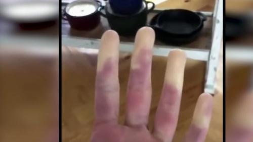 Froid : la maladie de Raynaud, un trouble de la circulation sanguine très répandu