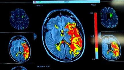 Les médicaments anti-rétroviraux sont peut-être à l'origine de cette hausse de risques d'attaques cérébrales (DR)