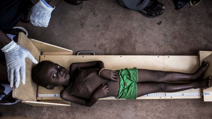  Un enfant souffrant de malnutrition accueilli dans un centre de santé de Tshikapa, dans la région du Kasaï, le 20 octobre 2017. (Photo AFP/John Wessels)