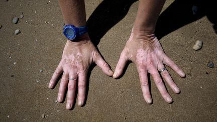 Les mains d'une personne atteinte de vitiligo, une maladie causant une dépigmentation sous la forme de taches blanches sur le visage et sur le corps, à Hyères (Var), le 5 août 2023. (MAGALI COHEN / HANS LUCAS / AFP)