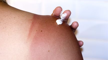 De la crème pour apaiser un coup de soleil. (BSIP / UNIVERSAL IMAGES GROUP EDITORIAL via GETTYIMAGES)