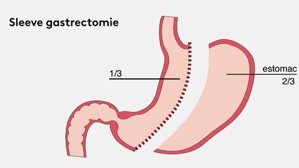 Obésité : la chirurgie gastrique comme recours.