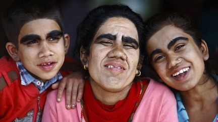 Devi Budhathoki (C) et ses enfants posent apr&egrave;s avoir &eacute;t&eacute; trait&eacute;s au laser &agrave; l'h&ocirc;pital de Kavre (N&eacute;pal), le 22 octobre 2013. La famille est atteinte d'hypertrichose universelle cong&eacute;nitale, une maladie qui se traduit par une pilosit&eacute; envahissante sur tout le corps. (NAVESH CHITRAKAR / REUTERS)