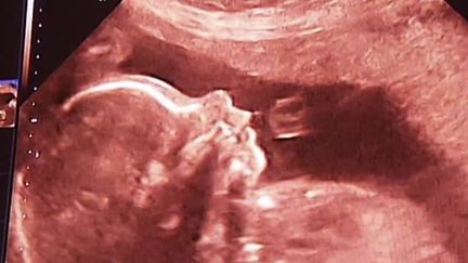 Ingérer de la Dépakine pendant une grossesse peut impacter le futur bébé. (FRANCEINFO)