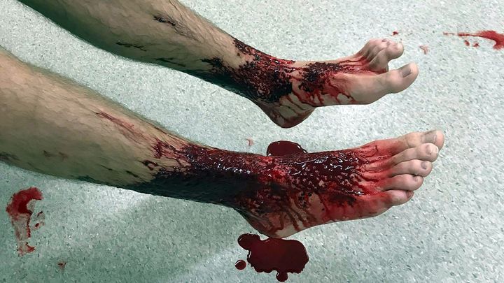 Les jambes de&nbsp;Sam Kanizay, à l'hôpital de Melbourne (Australie), le 5 août 2017. (JARROD KANIZAY / AFP)