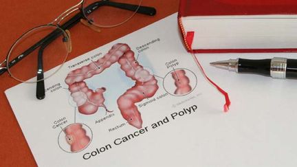 &nbsp; (Plus de 40.000 nouveaux cas de cancer colorectal sont détectés chaque année en France © MaxPPP)