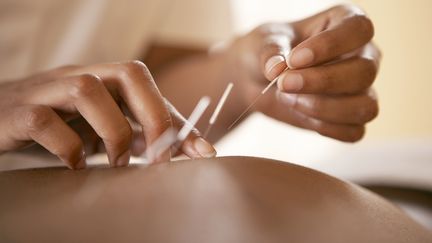 Illustration de l'une des "médecines" dites "douces", l'acupuncture. Comme la chiropractie, la sophrologie, ou l'homéopathie, ces soins sont considérés par la médecine traditionnelle, comme "non conventionnels", car ils n’ont pas été validés scientifiquement. (SCIENCE PHOTO LIBRARY - ADAM GAU / BRAND X / GETTY IMAGES)