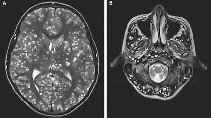 Un Indien meurt d’une invasion de larves de ténia dans son cerveau (&copy;NEJM)