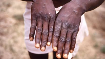 Les mains d'un patient atteint de mpox, le 27 septembre 2022, en République démocratique du Congo. (CDC / IMAGE POINT FR / AFP)