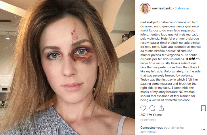 Capture écran du compte Instagram de Melissa Gentz, qui a publié une photo de son visage tuméfié le 26 septembre 2018. (MELISSA GENTZ / INSTAGRAM)