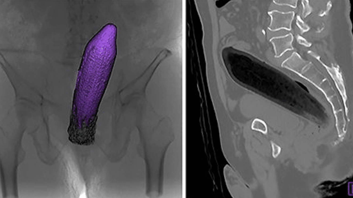 Vaginal multiple objects insertion - vnstat