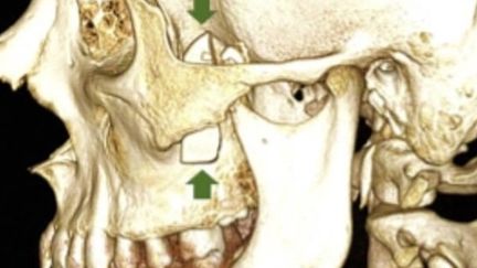 Il avait mal à la mâchoire… on lui retire un bout de verre de 3,5 cm ! (&copy; The Journal of Emergency Medicine)