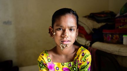 Sahana Katun présente un possible cas de "femme arbre" au Bangladesh, le 30 janvier 2017. (AFP)