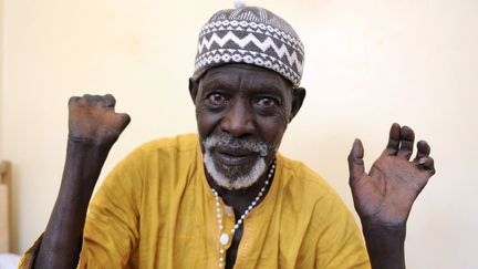 Un patient sénégalis atteint de la lèpre montrent ses mains après un traitement dans le Centre Hospitalier de l'Ordre de Malte (2014).  (SEYLLOU / AFP)