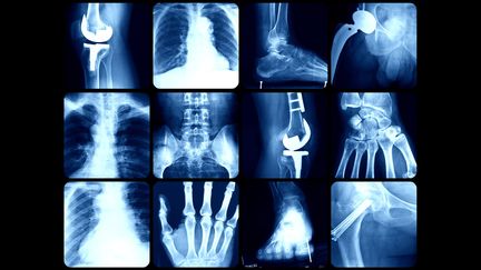 Implants et prothèses passés aux rayons X (illustration). (GETTY IMAGES)