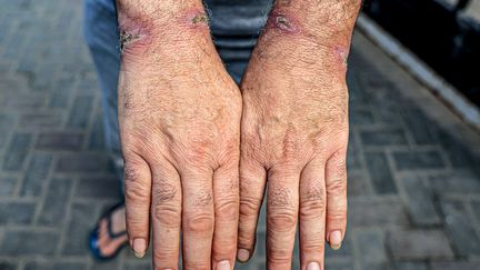 Un Palestinien libéré par l'armée israélienne montre ses blessures lors de son arrivée à l'hôpital al-Najjar, à Rafah, dans la bande de Gaza, le 24 décembre 2023. (SAID KHATIB / AFP)