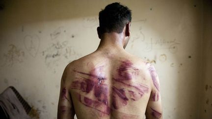 Un homme montre des traces de torture sur son dos, après son passage dans une prison gouvernementale près d'Alep (Syrie), le 23 juin 2012. (JAMES LAWLER DUGGAN / AFP)