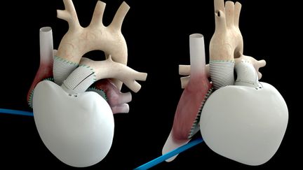 Les deux c&ocirc;t&eacute;s du c&oelig;ur artificiel Carmat. (MAXPPP)