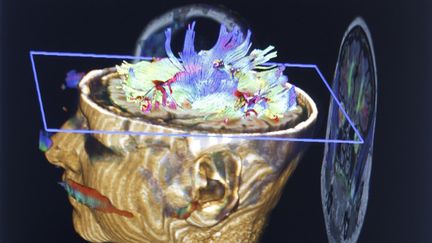 Une repr&eacute;sentation en 3D d'un cerveau d'enfant, obtenue gr&acirc;ce &agrave; une IRM. (BSIP / AFP)