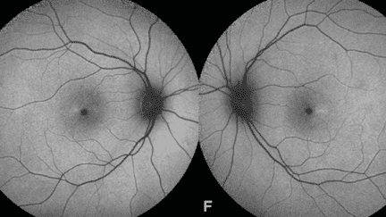 Il prend trop de viagra… et se met à voir rouge ! (&copy; Retinal Cases)