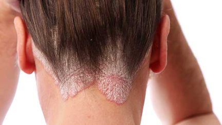 &nbsp; (le psoriasis est une maladie inflammatoire, que l'on soigne mais que l'on ne guérit pas. Elle est mal connue, mal perçue et mal vécue, selon l'association France Psoriasis © Maxppp)