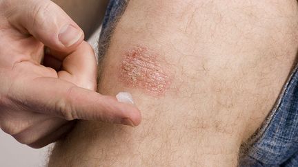 &nbsp; (La crème inventée par les scientifiques américains permet notamment de soigner les maladies de la peau comme le psoriasis  © MaxPPP)