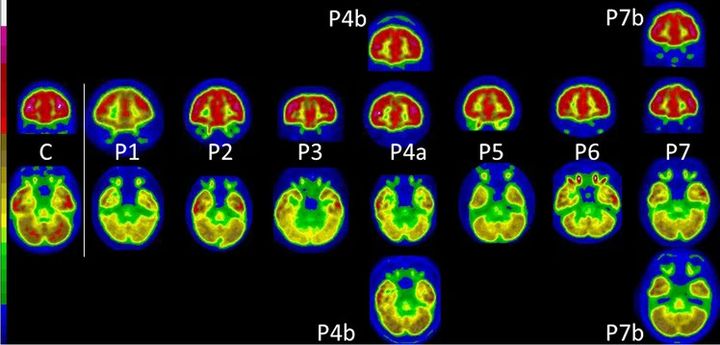 Image extraite de l'une des études des médecins de l'hopital de la Timone. (European Journal of Nuclear Medicine and Molecular Imaging)