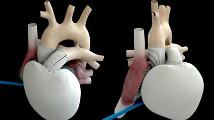 &nbsp; (Le type de coeur artificiel implanté à ce deuxième patient © Maxppp)