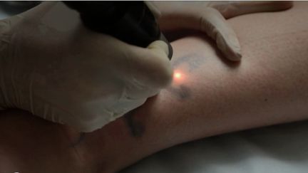 Près d'un Français sur cinq porte aujourd'hui un tatouage. Parfois, certains regrettent leur choix et s'orientent vers des séances de laser. (FRANCE 3)