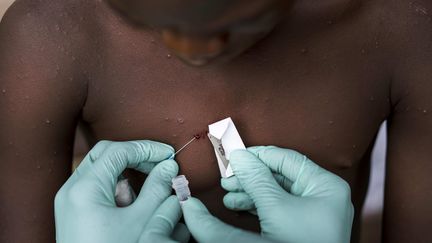 Prélèvement sur un jeune garçon suspecté d'avoir la variole du singe dans le département de la Likouala (République du Congo). (THE WASHINGTON POST / THE WASHINGTON POST via GETTYIMAGES)