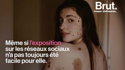 Son corps entier est couvert de grains de beauté, et pendant longtemps, elle a eu du mal à l'accepter. Mais la réaction d'un garçon a tout changé. La mannequin espagnole Alba Parejo raconte.