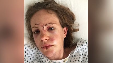 Pauline Sabin-Teyssèdre après son accident , le 31 mai 2017. (Pauline Sabin-Teyssèdre / Instagram)