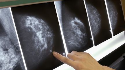 D&eacute;tail d'une mammographie lors d'un d&eacute;pistage du cancer du sein. (LESTER LEFKOWITZ / GETTY IMAGES)