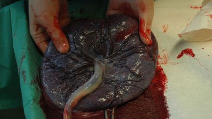 Un placenta après un accouchement. (&copy;&nbsp; Inferis sur Wikip&eacute;dia)