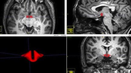 En rouge : l'hypothalamus, plus petit chez les femmes qui prennent la pilule. (Cr&eacute;dits Photo : &copy; RSNA / Dr M. Lipton)