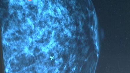 L’intelligence artificielle améliore le dépistage des cancers du sein