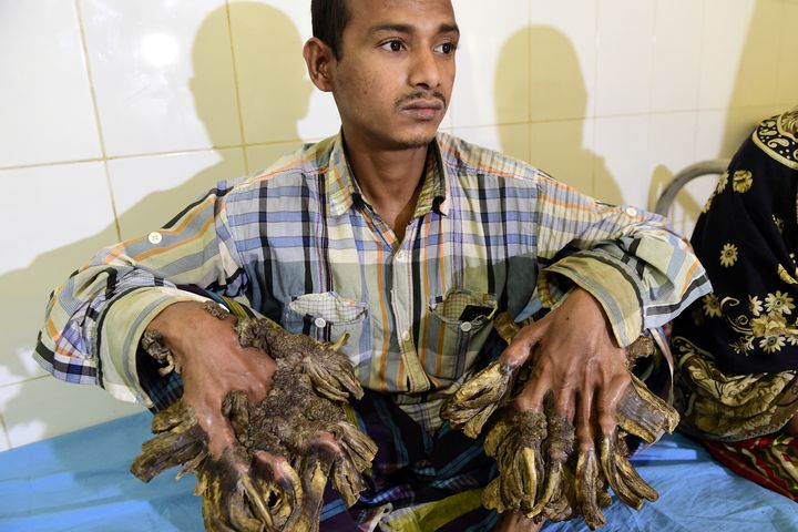 Abul Bajandar avant son opération à Dacca (Bangladesh), le 31 janvier 2016. (MUNIR UZ ZAMAN / AFP)