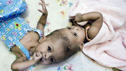 Les soeurs siamoises Rital et Ritag Gaboura avant d'&ecirc;tre s&eacute;par&eacute;es avec succ&egrave;s dans un h&ocirc;pital londonien (Royaume-Uni). (AP / SIPA)