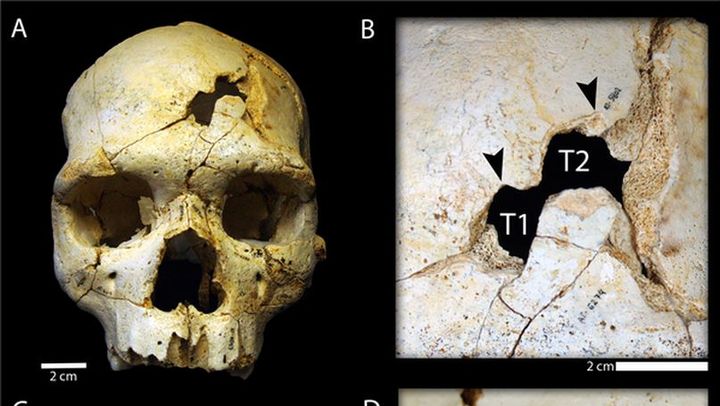 Les deux fractures ont &eacute;t&eacute; observ&eacute;es sur un cr&acirc;ne d'homo heidelbergensis, datant de 430 000 ans et d&eacute;couvert en Espagne. (PLOS ONE)