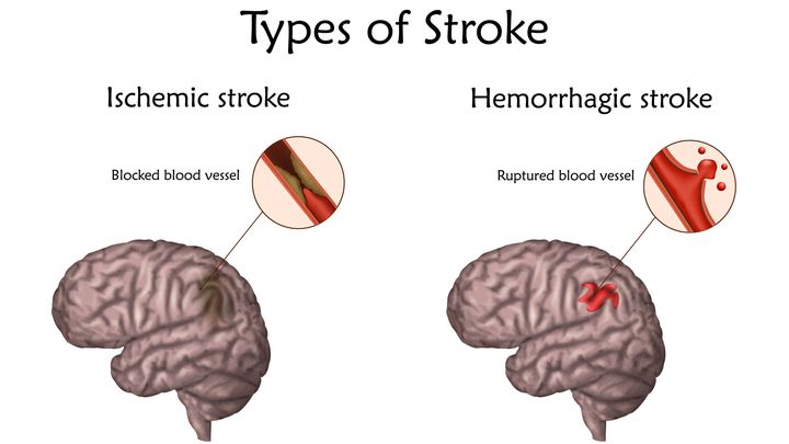 Les AVC sont des anomalies brutales dans l’arrivée du sang au niveau du cerveau.&nbsp;Soit parce qu’un vaisseau se bouche&nbsp;: alors, l’oxygène n’arrive plus dans certaines zones. Soit parce qu’un vaisseau se perce et crée une hémorragie qui est aussi dangereuse. (VERONIKA ZAKHAROVA / SCIENCE PHOTO LIBRARY RF / GETTY IMAGES)