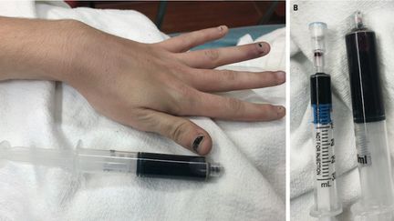 Une femme s'est présentée à l’hôpital avec le sang complètement bleu (Cr&eacute;dits Photo : Warren &amp; Blackwood, NEJM 2019)