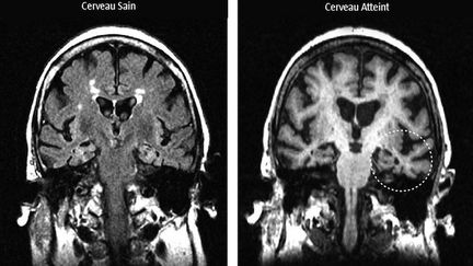 Un test pour détecter Alzheimer 20 ans avant les premiers symptômes ?