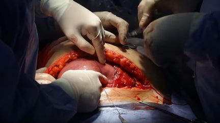 La chirurgie in utero est plus efficace qu'une opération réalisée après l'accouchement (&copy; Dr. Wael Elbanna -&nbsp; د. وائل البن)