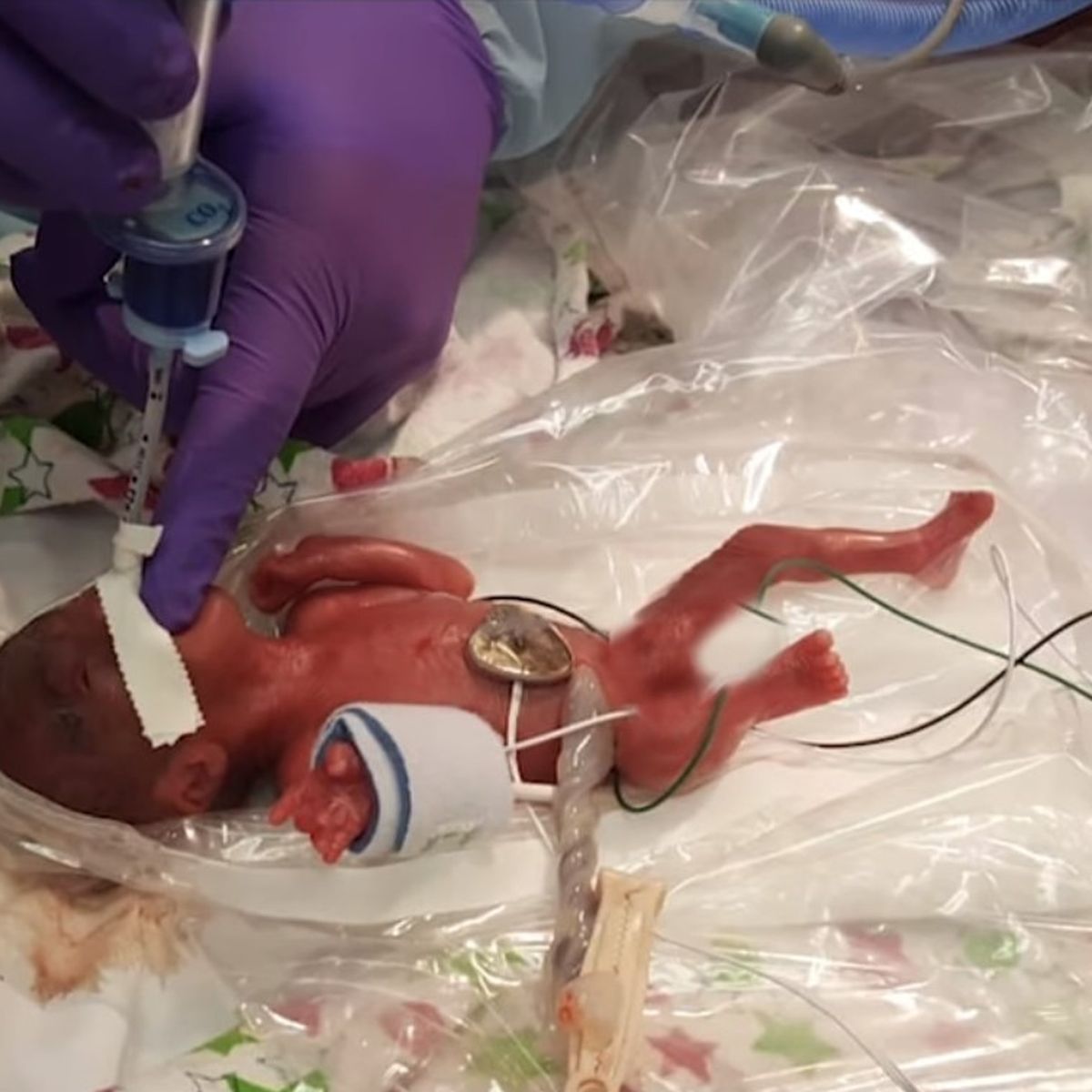 Video Californie Le Plus Petit Bebe Ne En Vie Au Monde Quitte L Hopital Apres Cinq Mois De Soins