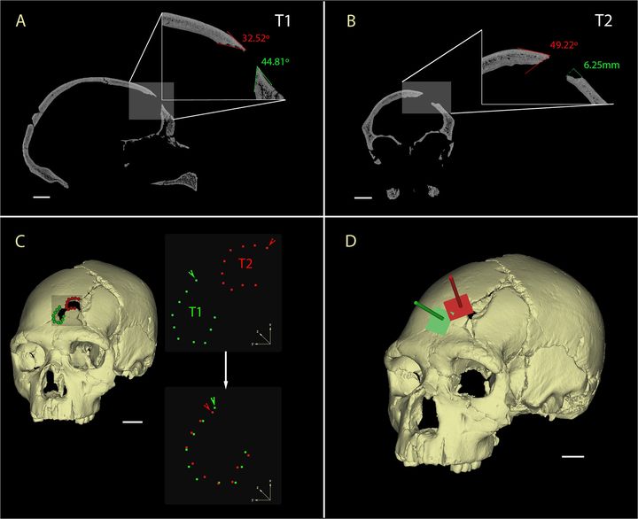 Mod&eacute;lisation du cr&acirc;ne retrouv&eacute; en Espagne, sur lequel sont mises en &eacute;vidence deux fractures similaires, sugg&eacute;rant l'usage d'un outil unique &agrave; plusieurs reprises. (PLOS ONE)