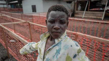 Un patient atteint de mpox dans un hôpital de Goma, en République démocratique du Congo, le 16 août 2024. (GUERCHOM NDEBO / AFP)